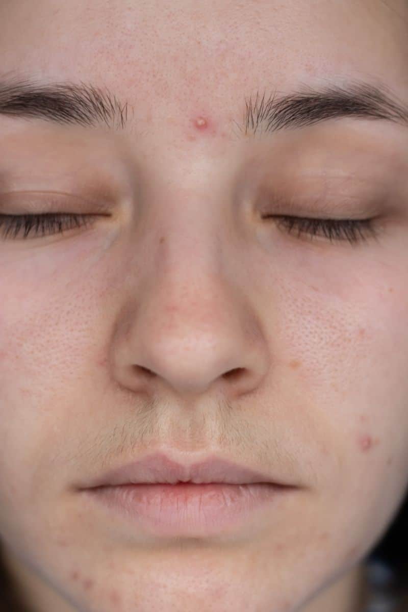 pimple between eyebrows spiritual meaning and meaning